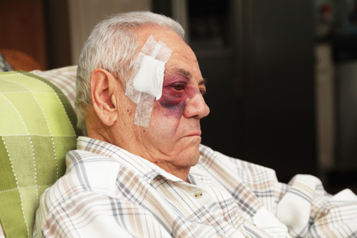 A man with a dreadful blotchy black and blue (and red) eye also has a large bandage covering several medical stitches in his temple after a car accident.